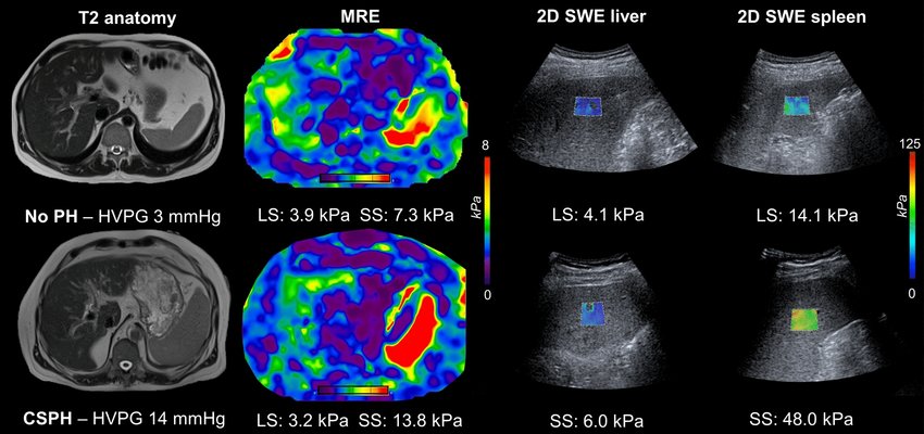 Example-MR-elastography-MRE-and-ultrasound-shear-wave-elastography-2D-SWE-images-from